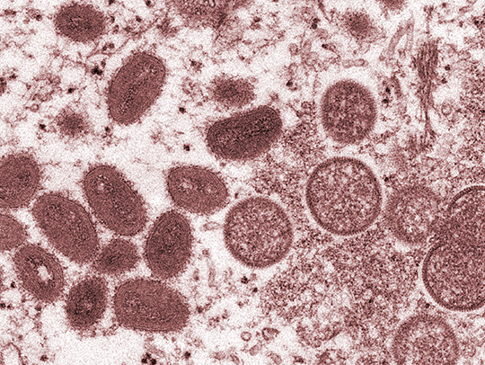 A microscopy image of (L-R) mature monkeypox virus particles and immature monkeypox virons. Credit: CDC/Cynthia Goldsmith.